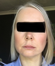 My droopy jowl mini face lift result pics