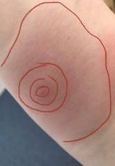 AIBU to think this is not a normal midge bite?