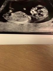 12 week scan - boy or girl?