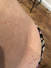 Any idea what this rash may be?