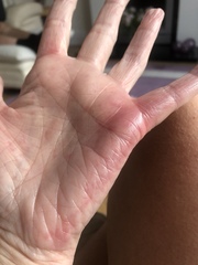 Itching hands and feet only -  anyone pic included
