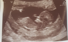 12 week scan, Boy or girl?
