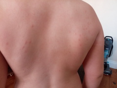 Daughter has a rash (no spleen)