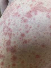 Any idea what this rash may be?