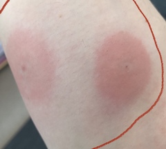 AIBU to think this is not a normal midge bite?