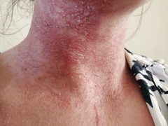 Infected eczema or something else?