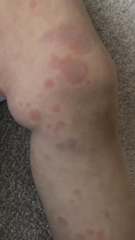 Weird rash on four year old (contains photos)