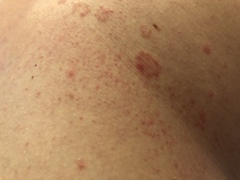 Any idea what this rash may be?