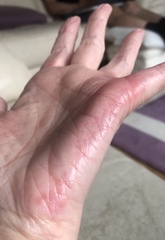 Itching hands and feet only -  anyone pic included