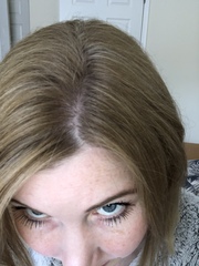 Hair loss...
