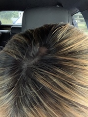 Bald spots on my head