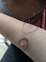What the heck has bitten me?!