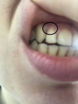 Can't stop thinking about receding gums, I'm terrified - any advice? - Photos inc