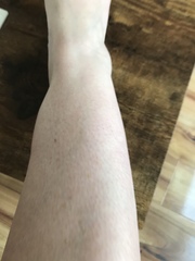 Why are my legs swollen? Pics