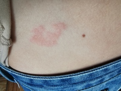 Weird rash in one spot.