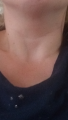 Anyone with any swollen thyroid/nodule knowledge? Images included