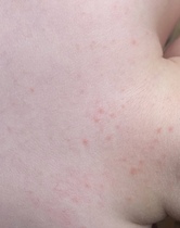 Child rash and node three weeks after Covid-19