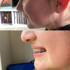 Twin Block Braces - Any Advice?