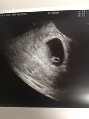 Pregnant After MMC - Thread 2