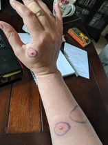 What the heck has bitten me?!