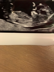 12 week scan - boy or girl?