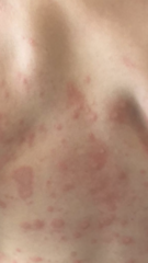 Weird rash on four year old (contains photos)