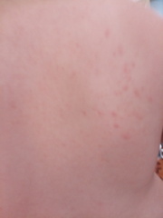 Daughter has a rash (no spleen)