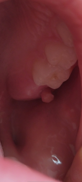 What's this lump on child's gum?