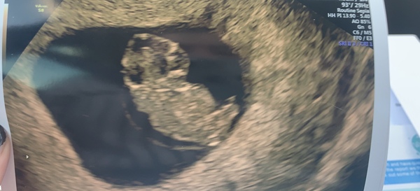 Pregnant After MMC - Thread 2