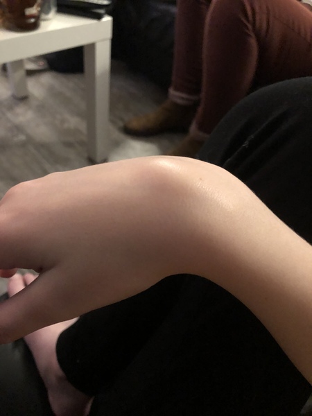 Lump on hand