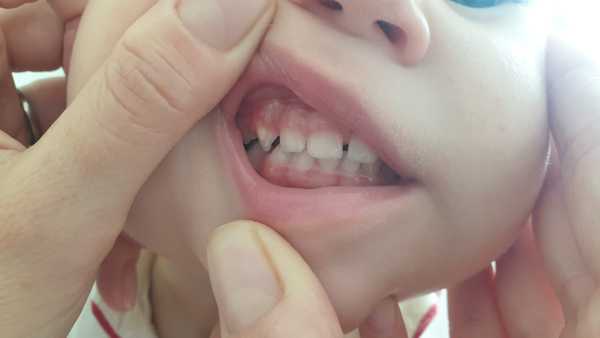 2yo dentistry, weird tooth and gum