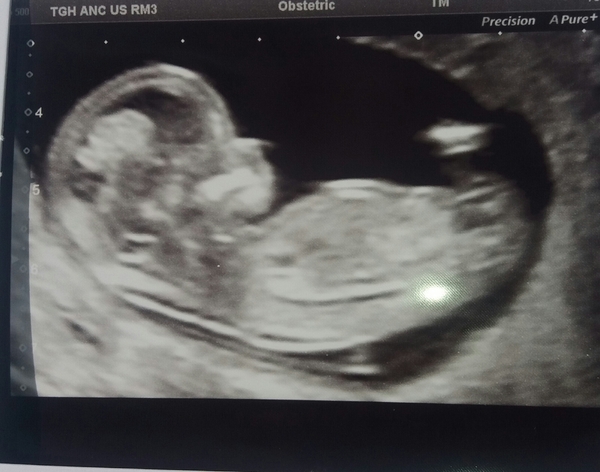 Pregnant After MMC - Thread 2