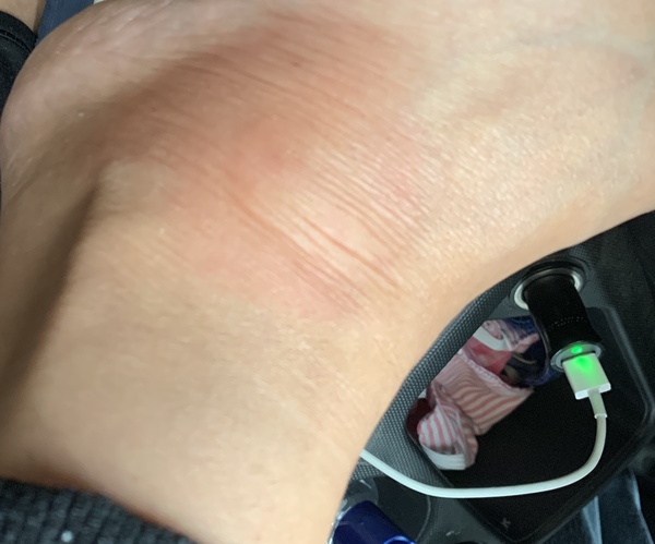 Should a bite hurt this much 3 days later?!