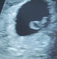 Pregnant After MMC - Thread 3
