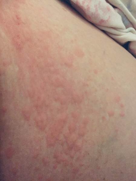 God help me i'm so bloody itchy! What is it?