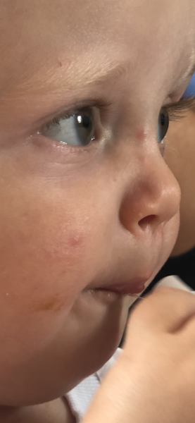 What could these spots be on my sons face?