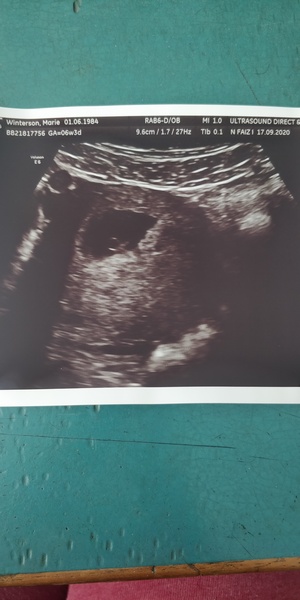 Stories after 2 early miscarriages - I really need to read other people’s stories 😭😭😭