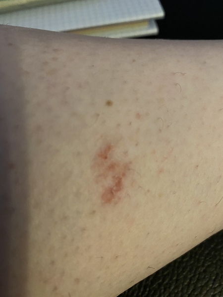 What on EARTH are these patches all over my body..?