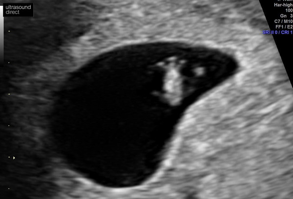 Early pregnancy scan stories please!