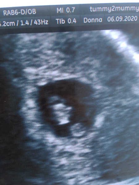 Pregnant After MMC - Thread 2