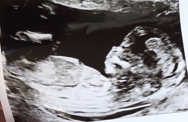 13 week gender guess