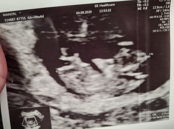 Catching up - TTC After Miscarriage part 3