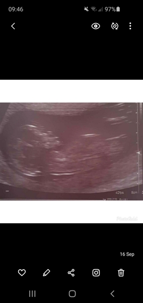12 week scan