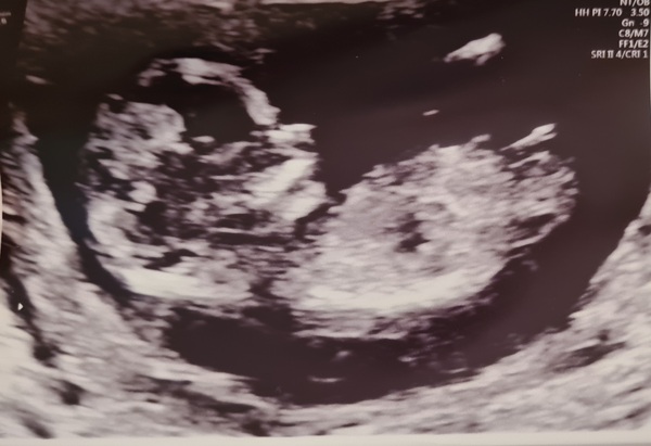 Nub theory/ boy or girl? 🥰