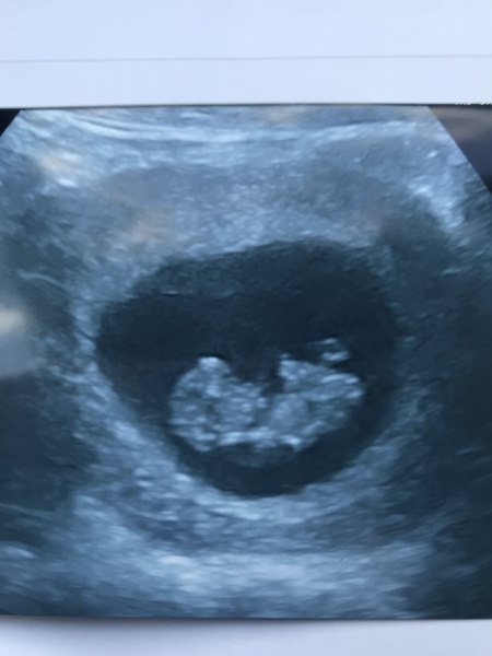 Early pregnancy scan stories please!