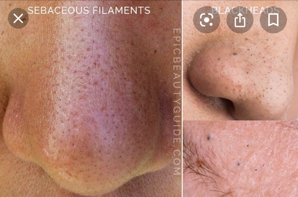 Best advice for 8yr old's blackheads :(