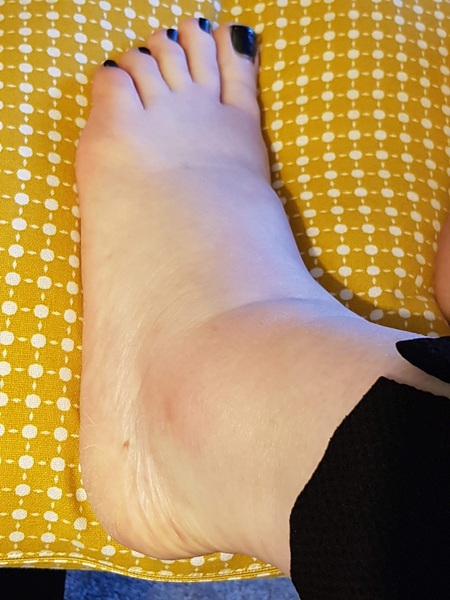 Come and tell me about your bad ‘sprains’ ( pic included)