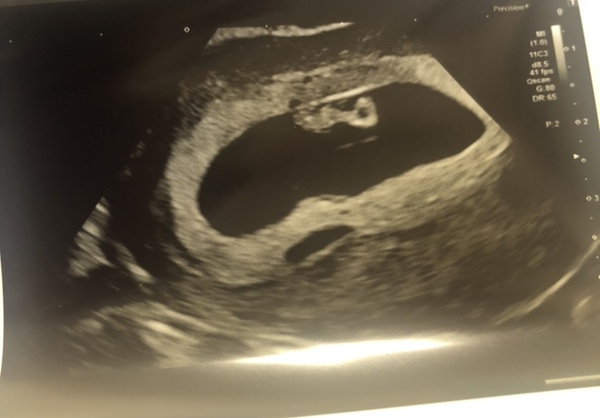Ramzi theory anyone? 7 weeks scan