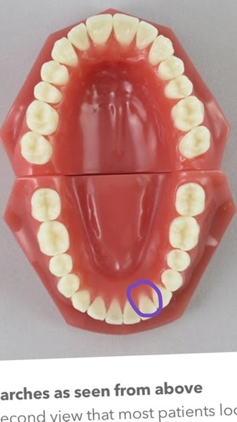 Part of tooth came away