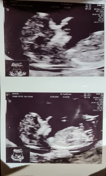 Catching up - TTC After Miscarriage part 3